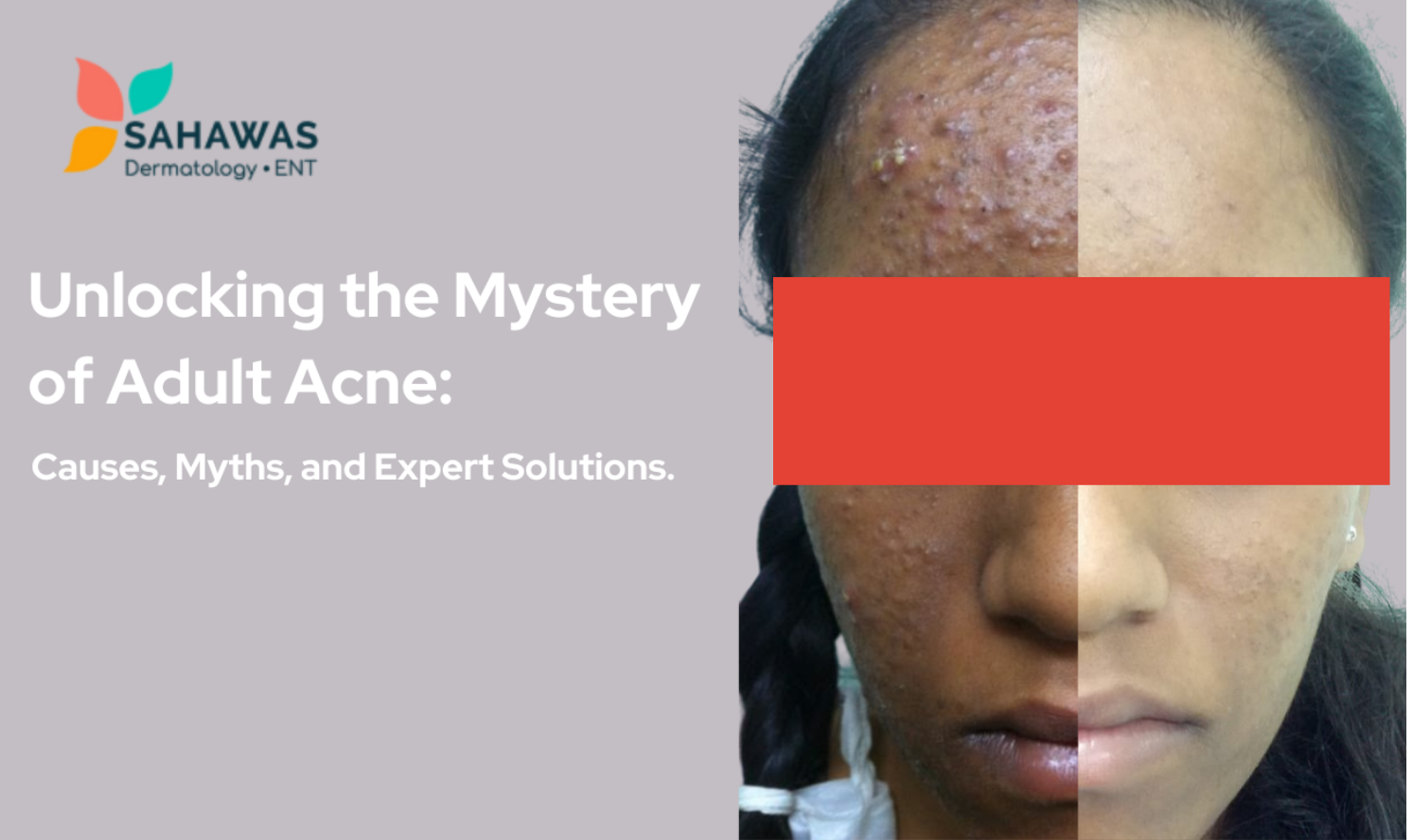 Unlocking the Mystery of Adult Acne: Causes, Myths, and Expert Solutions.